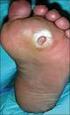 INFECTION DU PIED DIABÉTIQUE