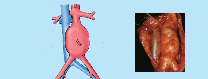 VI-APPLICATION CLINIQUE : 1-L Anévrisme de l aorte abdominale dilatation des parois de la portion abdominale de l aorte