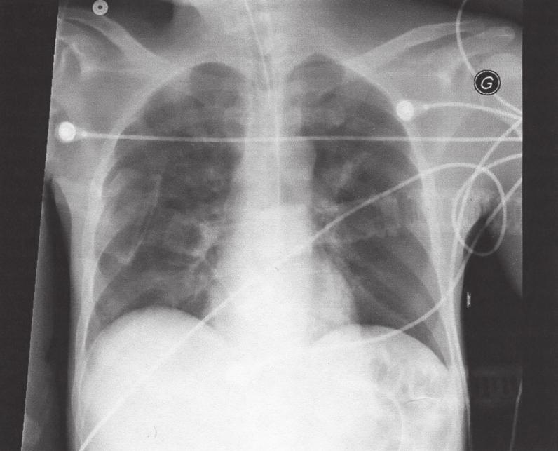 Repères anatomiques radiographiques a radiographie pulmonaire permet de déterminer la présence d anomalies et de pathologies qui seraient autrement impossibles à L détecter et d en suivre l évolution.