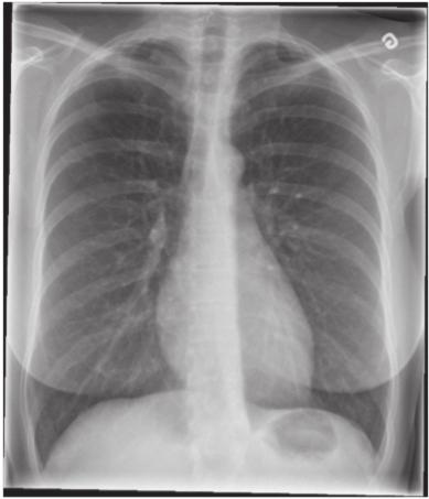 G Repères anatomiques radiographiques 52 Radiographies pulmonaires antérieures chez deux sujets sains G 3 5 8 4 6 2 7 4 1 9 1 Poche d air