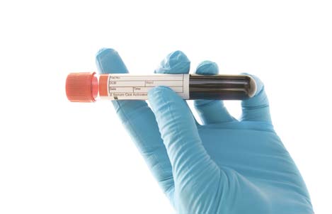 » Anti-HBs (anticorps à l antigène de surface de l hépatite B) Ce test mesure l anticorps protecteur qui se développe contre le virus de l hépatite B.
