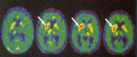 CEA-DSM-DAPNIA -T14 Autre exemple : l observation par TEP, avant (à gauche), puis 3, 6 et 12 mois après une greffe de