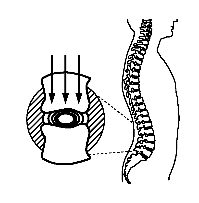 Ces vertèbres sont réparties en trois régions : 7 cervicales, 12 dorsales et 5 lombaires et elles sont de plus en plus épaisses à mesure que l on s approche du bas de la colonne.