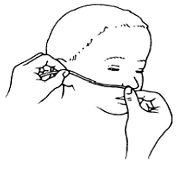 A. Mesurez la distance entre la narine et le tragus de l oreille pour introduire le cathéter nasopharyngé B.