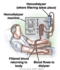 Hemodialyzer = Hémodialyseur (où a lieu la filtration) Hemodialyzer machine = Appareil d hémodialyse Filtered blood = Sang filtré renvoyé dans l organisme Blood flows = Sang