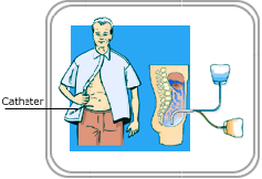 La cavité péritonéale est l espace situé autour des intestins et des autres organes de l abdomen (ventre).