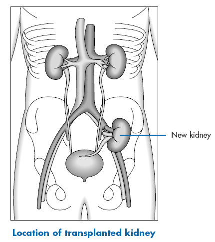 New kidney = Nouveau rein Location of, etc. = Emplacement du rein transplanté La liste d attente pour obtenir un rein d un donneur décédé ne cesse de s allonger.