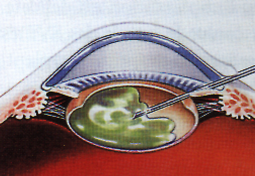 Etape 3 : une fois ce visco-élastique injecté, le chirurgien réalise une fenêtre circulaire dans la capsule avant du cristallin Etape 4 : La phase suivante est appelée phacoémulsification, permettant
