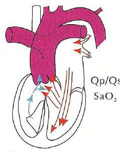Physiopathologie Cardiopathie à sang mélangé Le débit pulmonaire dépend des résistances vasculaires pulmonaires. Cyanose modérée à la naissance.