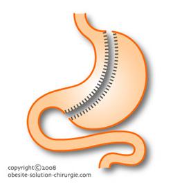6.3. Sleeve gastrectomie ou gastrectomie longitudinale C est une technique restrictive consistant à retirer environ les 2/3 de l estomac et ce de manière longitudinale.