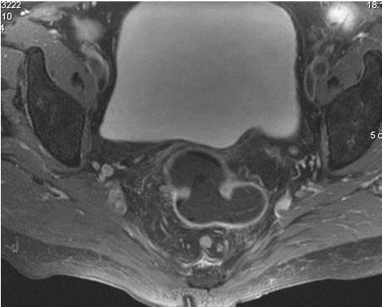 Interprétation : Tumeurs moyen, haut rectum 6-Statut ganglionnaire Qu en est il, plus de 10 ans après? Bellin MF, Roy C, Kinkel K et al. Lymph nodes metastases.