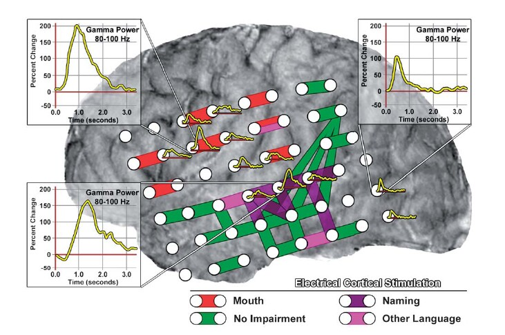3.3. Activités haute fréquence en EEG intracérébral chez l homme et processus cognitifs de tâches motrices avec la bouche, avec une bonne spécificité mais une sensibilité relativement faible (figure 3.