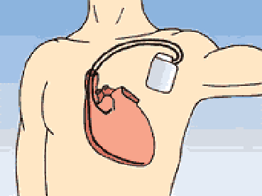 Sonde atriale: stimulation/détection bradycardie détection tachycardie ± stimulation antitachycardique A Défibrillateur: cardioversion