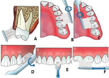 CHAPITRE IV : LES MOYENS DE LUTTE CONTRE LE BIOFILM Figure 39 :Angulation de la brosse à dent à 45 par rapport à la couronne dentaire. (SVOBODA, J-M., DUFOUR, T.