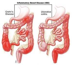 Différences morphologiques entre maladie de Crohn et rectocolite hémorragique Crohn RCH