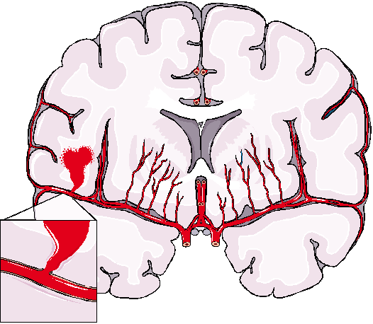126 L unité neuro-vasculaire 6.2 Contexte de l étude Un accident vasculaire cérébral (AVC), aussi appelé «attaque cérébrale», est un déficit neurologique soudain d origine vasculaire.