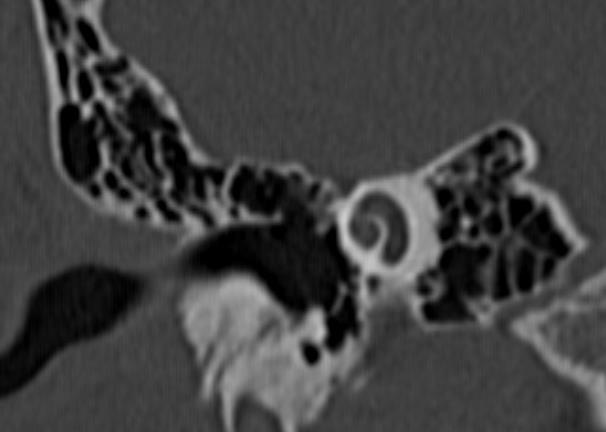 4/ LE LABYRINTHE OSSEUX: A/Le labyrinthe antérieur: Structure intraluminale hypodense et osseuse hyperdense Modiolus Forme : aspect de limaçon de 2 tours de spire et ½ sur les coupes coronales