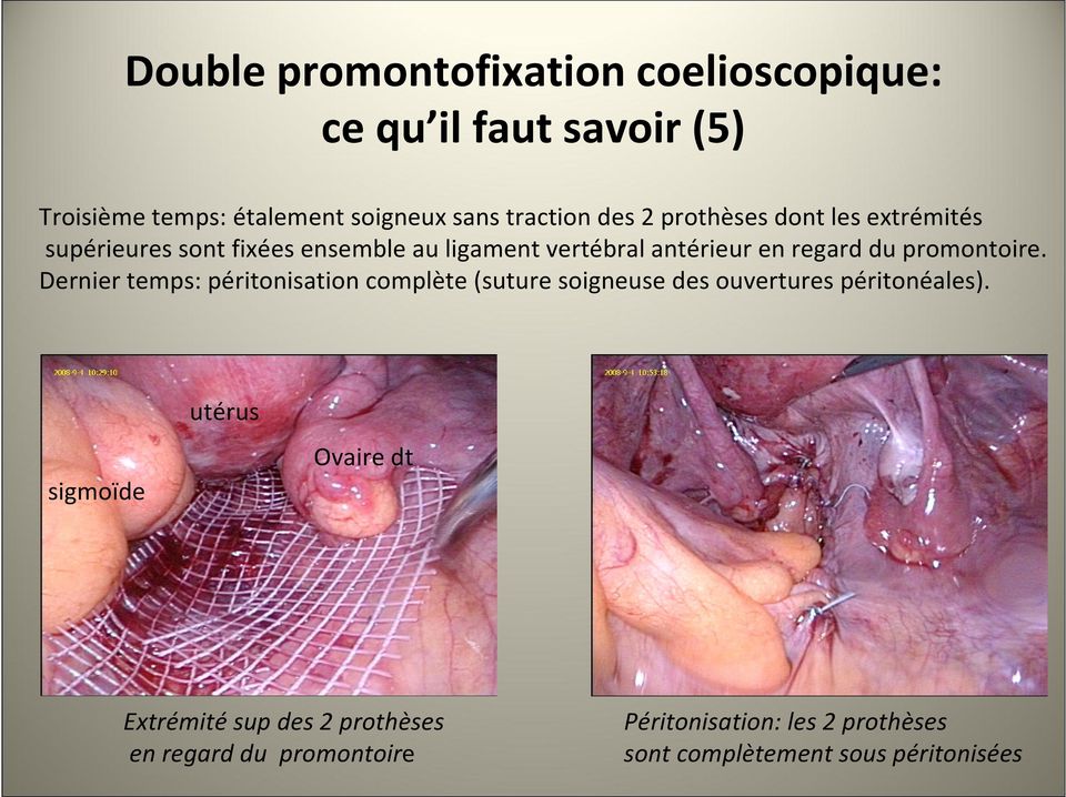 promontoire. Dernier temps: péritonisation complète (suture soigneuse des ouvertures péritonéales).