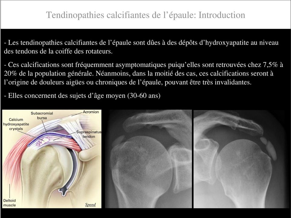 Tendinopathies calcifiantes de l épaule: Ponction-lavage-aspiration sous  contrôle échographique - PDF Free Download
