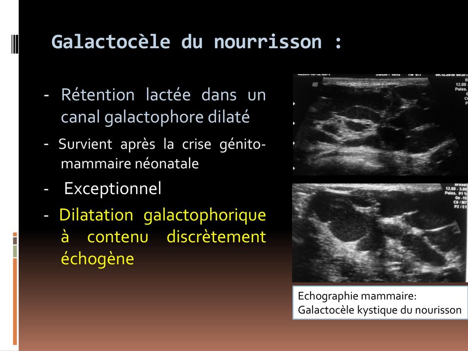 néonatale - Exceptionnel - Dilatation galactophorique à contenu