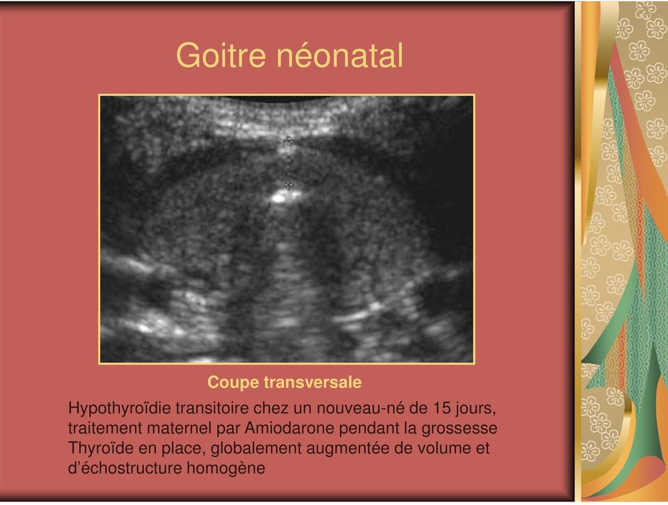 maternel par Amiodarone pendant la grossesse Thyroïde en