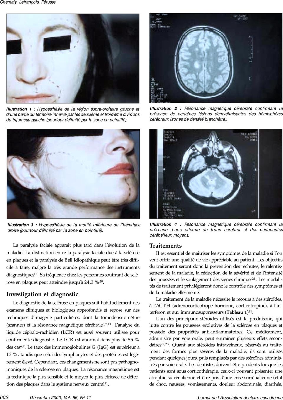 Illustration 2 : Résonance magnétique cérébrale confirmant la présence de certaines lésions démyélinisantes des hémisphères cérébraux (zones de densité blanchâtre).