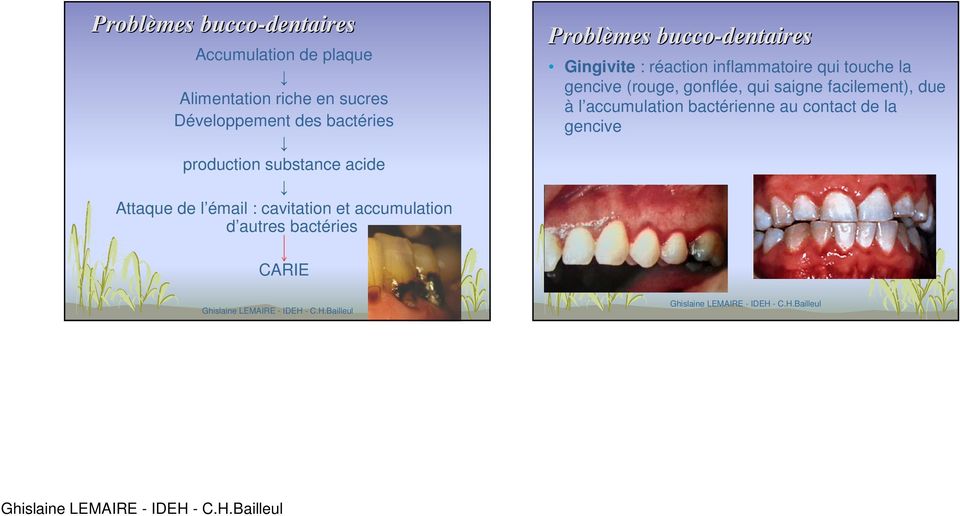 bactéries Problèmes bucco-dentaires Gingivite : réaction inflammatoire qui touche la gencive
