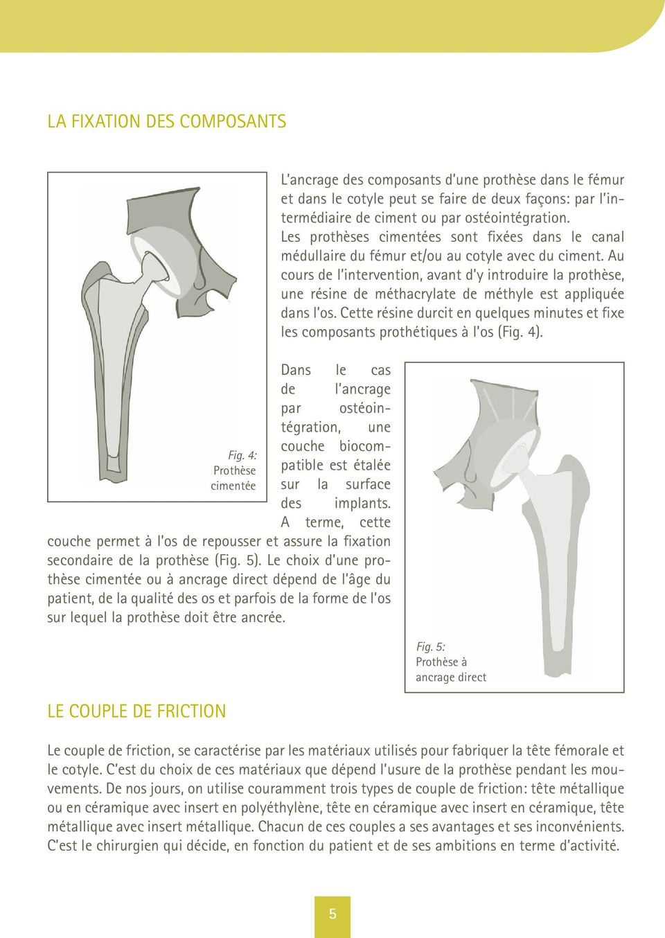 Le choix d une prothèse cimentée ou à ancrage direct dépend de l âge du patient, de la qualité des os et parfois de la forme de l os sur lequel la prothèse doit être ancrée.
