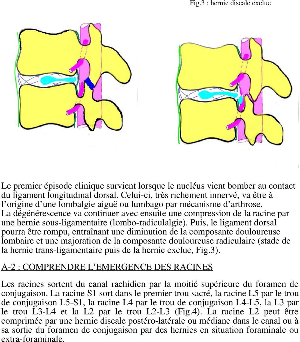La dégénérescence va continuer avec ensuite une compression de la racine par une hernie sous-ligamentaire (lombo-radiculalgie).