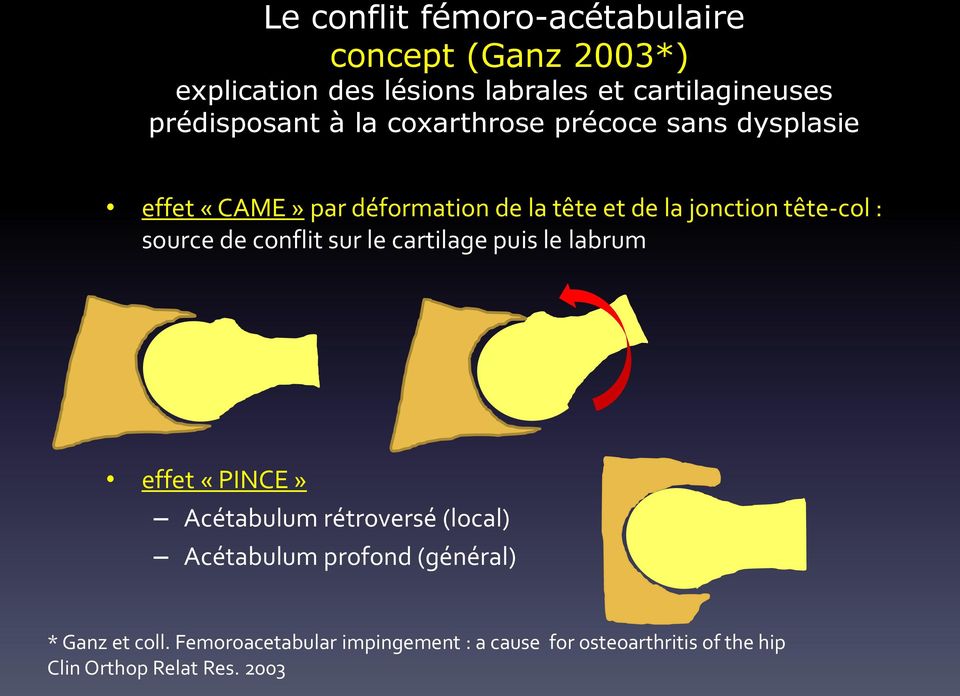 tête-col : source de conflit sur le cartilage puis le labrum effet «PINCE» Acétabulum rétroversé (local) Acétabulum