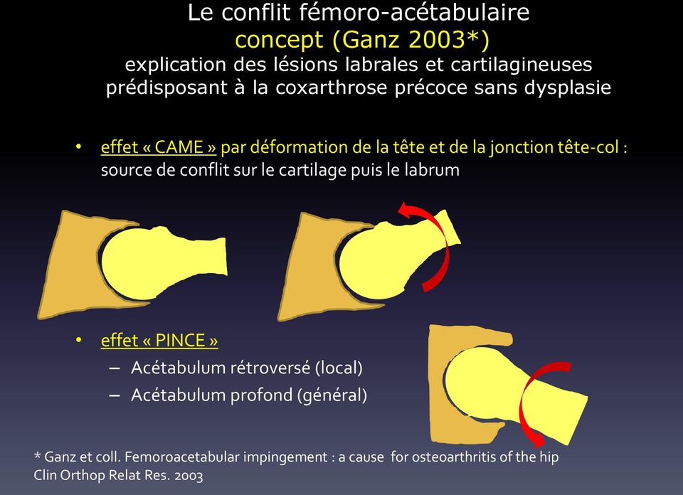 tête-col : source de conflit sur le cartilage puis le labrum effet «PINCE» Acétabulum rétroversé (local) Acétabulum
