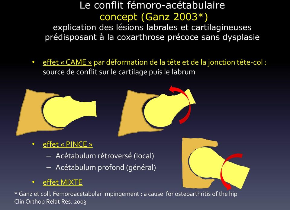conflit sur le cartilage puis le labrum effet «PINCE» Acétabulum rétroversé (local) Acétabulum profond (général) effet