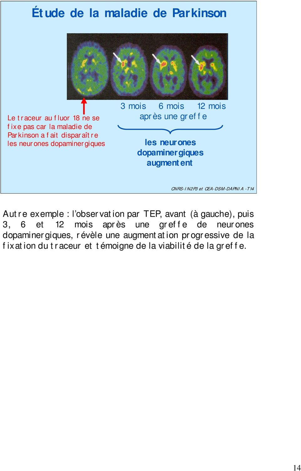 CEA-DSM-DAPNIA -T14 Autre exemple : l observation par TEP, avant (à gauche), puis 3, 6 et 12 mois après une greffe de