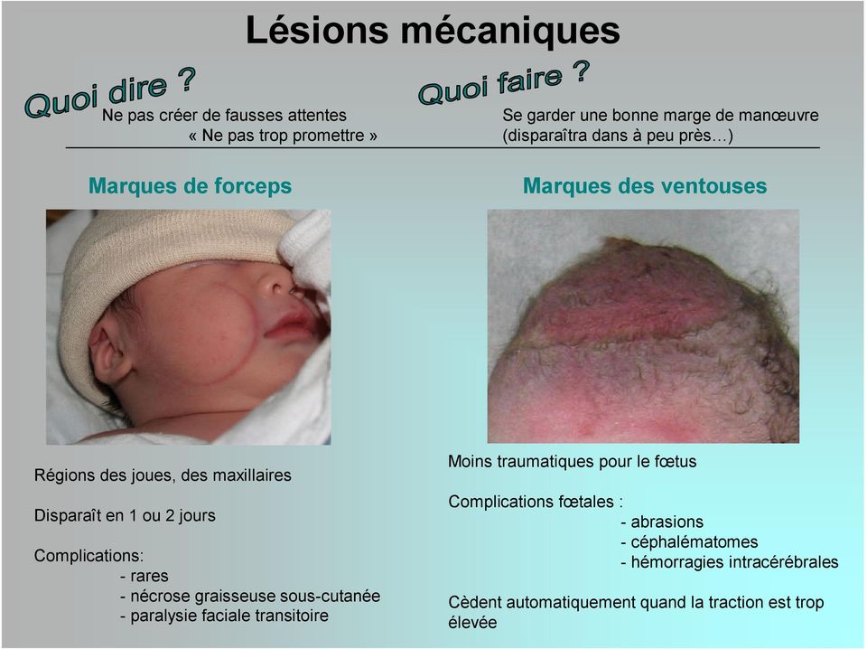 Complications: - rares - nécrose graisseuse sous-cutanée - paralysie faciale transitoire Moins traumatiques pour le fœtus