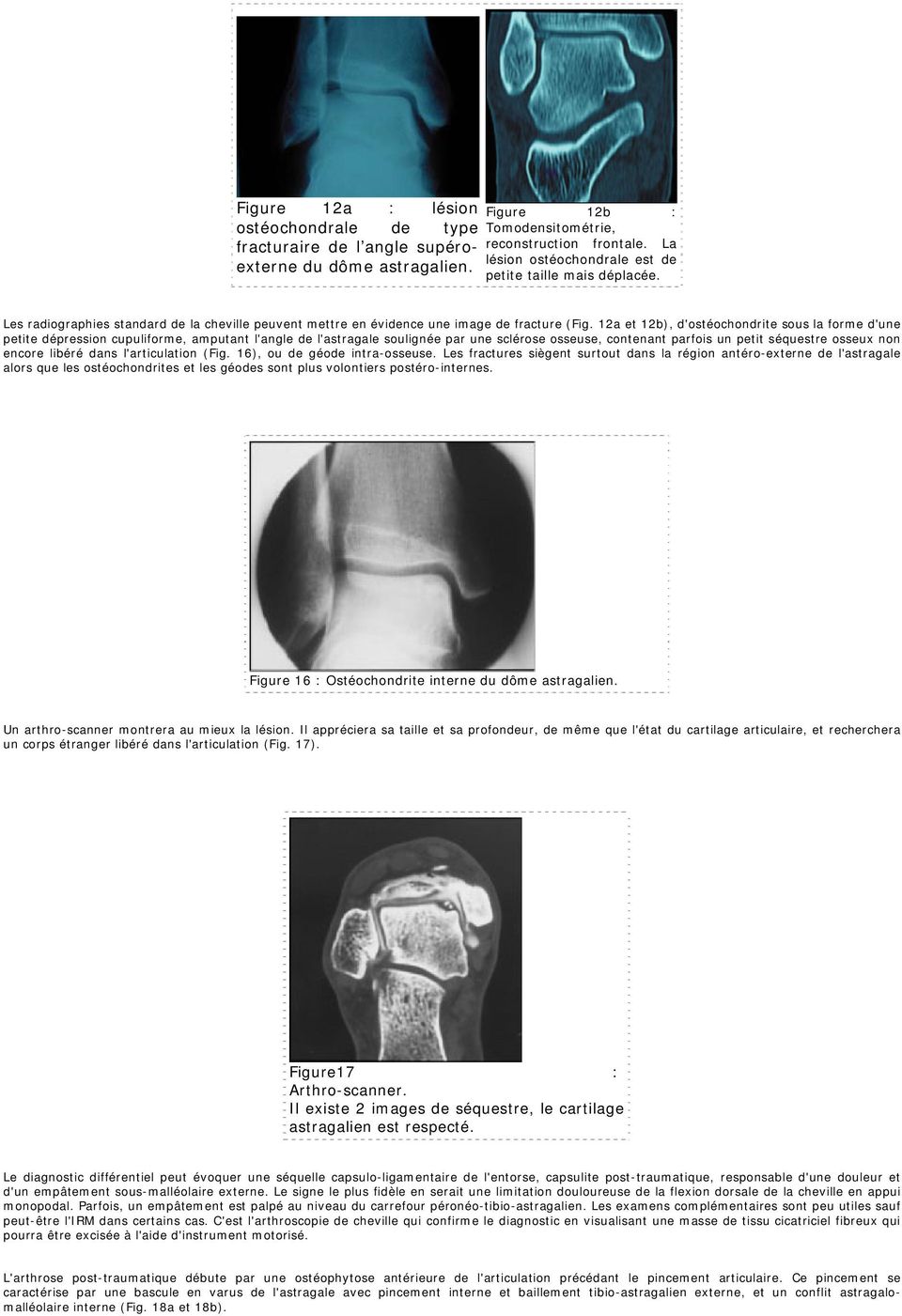 12a et 12b), d'ostéochondrite sous la forme d'une petite dépression cupuliforme, amputant l'angle de l'astragale soulignée par une sclérose osseuse, contenant parfois un petit séquestre osseux non