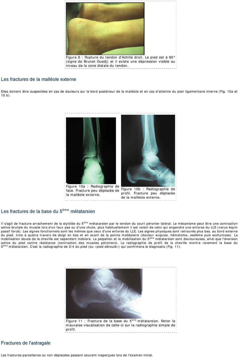 Figure 10a : Radiographie de face. Fracture peu déplacée de Figure 10b : Radiographie de la malléole externe. profil. Fracture peu déplacée de la malléole externe.