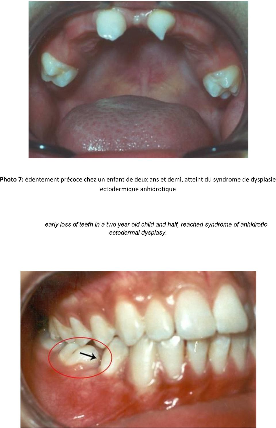 anhidrotique early loss of teeth in a two year old child