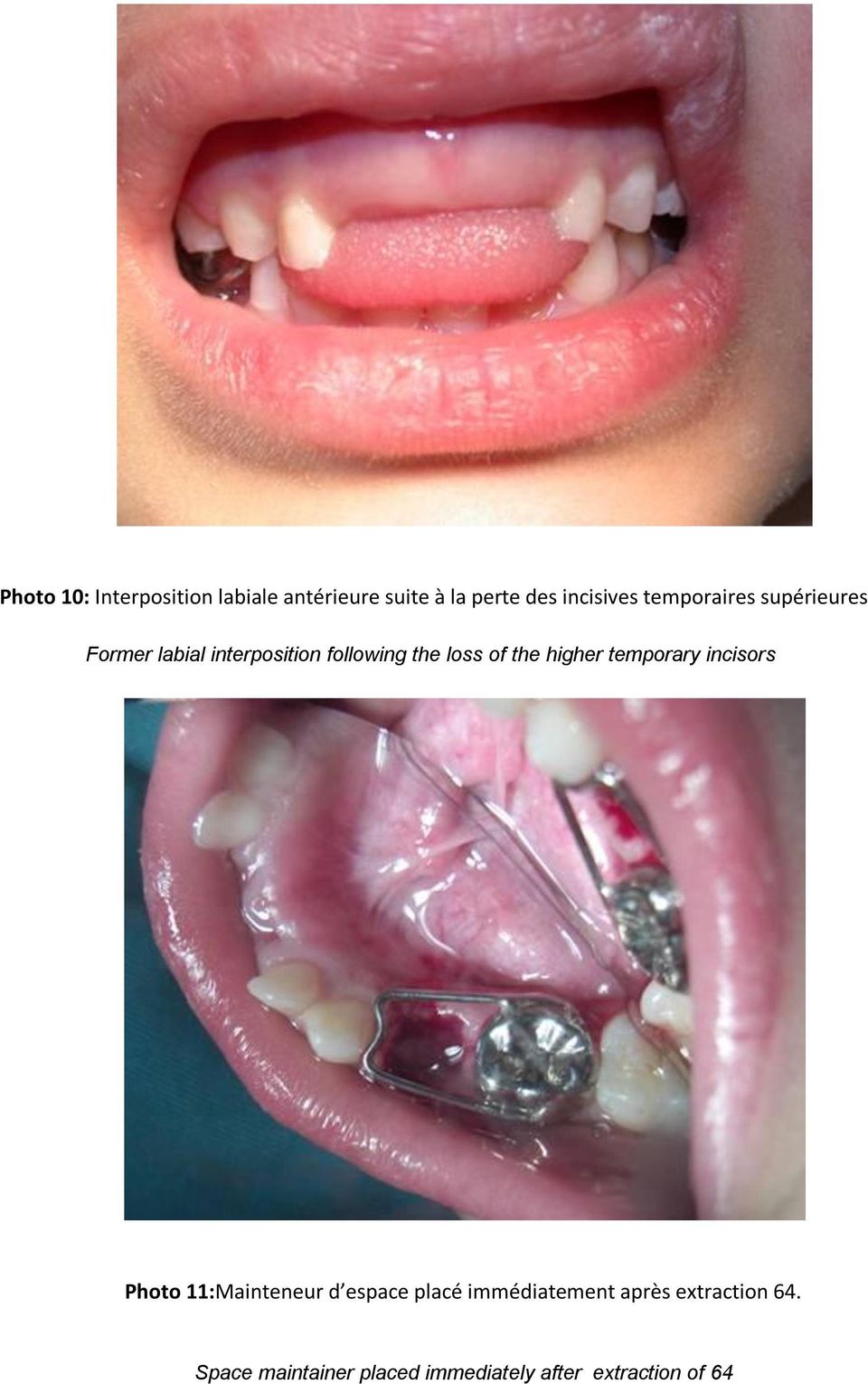 the higher temporary incisors Photo 11:Mainteneur d espace placé