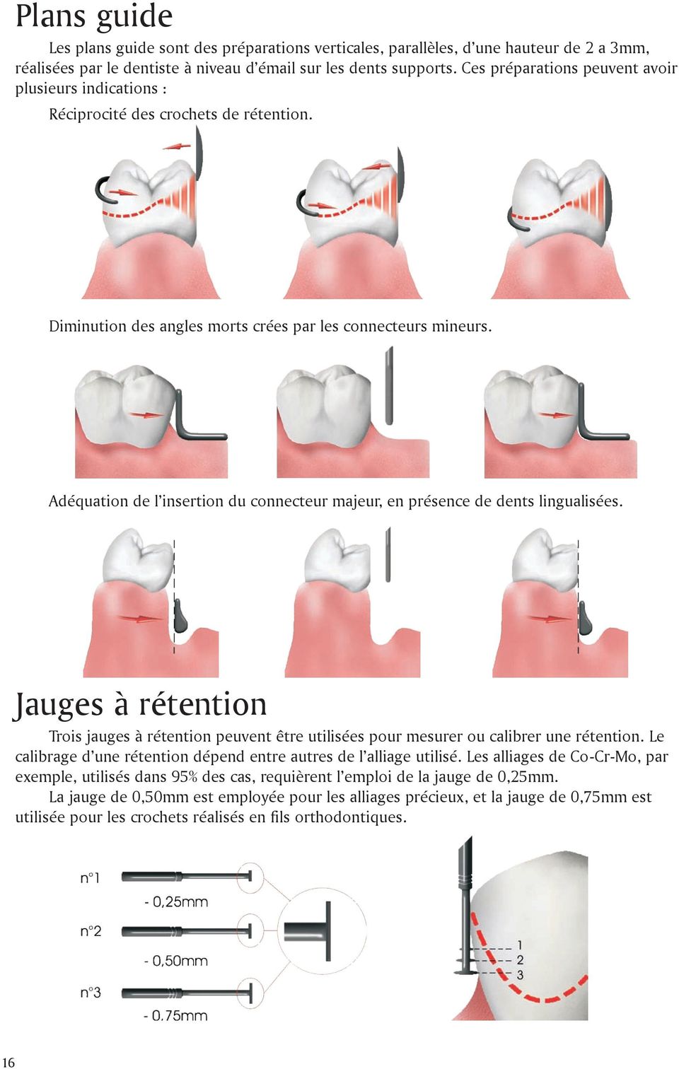 Adéquation de l insertion du connecteur majeur, en présence de dents lingualisées. Jauges à rétention Trois jauges à rétention peuvent être utilisées pour mesurer ou calibrer une rétention.