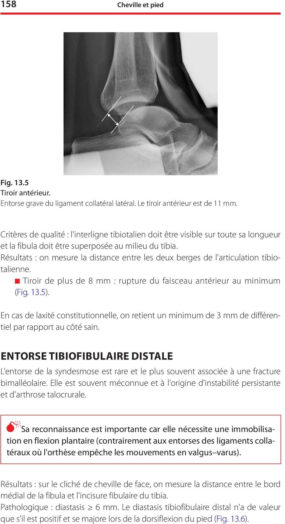 Résultats : on mesure la distance entre les deux berges de l'articulation tibiotalienne. n Tiroir de plus de 8 mm : rupture du faisceau antérieur au minimum (Fig. 13.5).