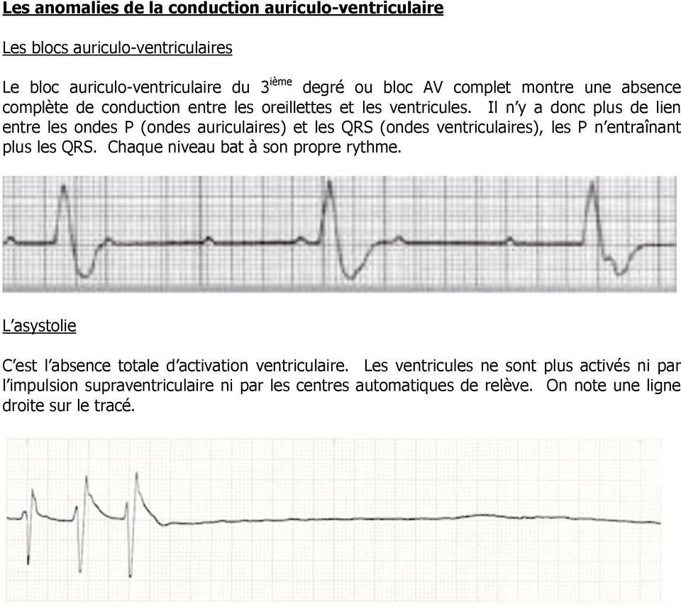 Il n y a donc plus de lien entre les ondes P (ondes auriculaires) et les QRS (ondes ventriculaires), les P n entraînant plus les QRS.