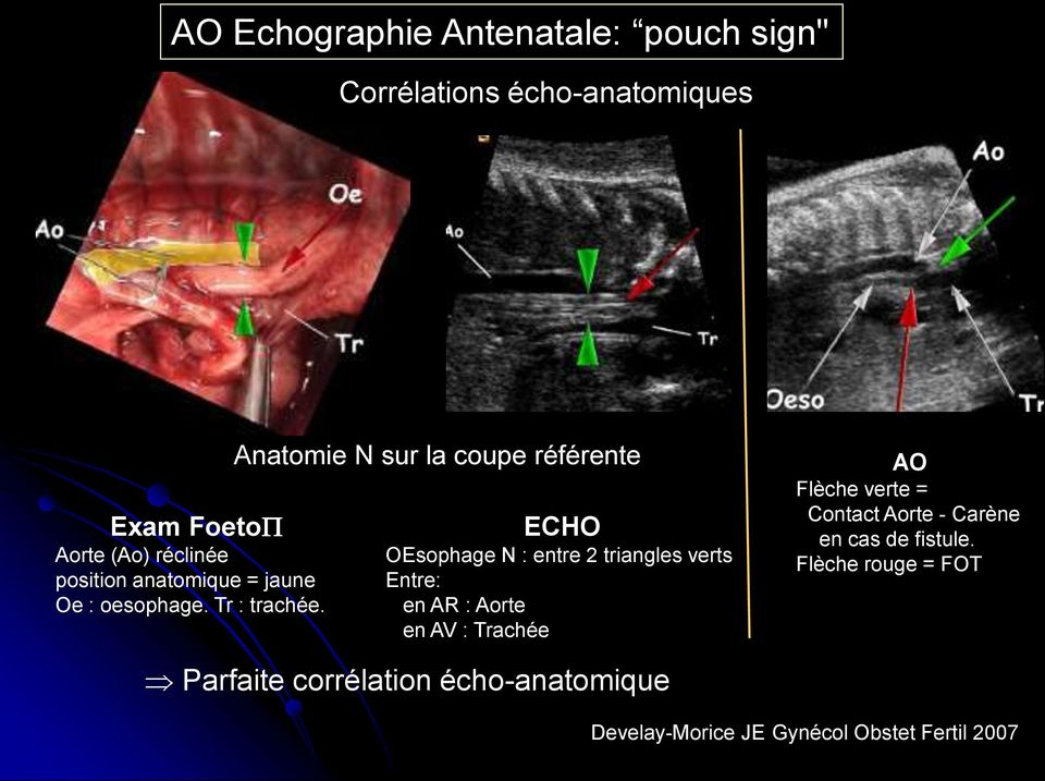 Anatomie N sur la coupe référente ECHO OEsophage N : entre 2 triangles verts Entre: en AR : Aorte en AV :
