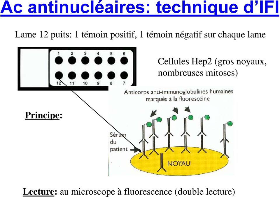 Cellules Hep2 (gros noyaux, nombreuses mitoses)