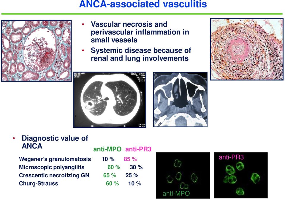 ANCA anti-mpo Wegener s granulomatosis 10 % 85 % anti-pr3 Microscopic polyangiitis