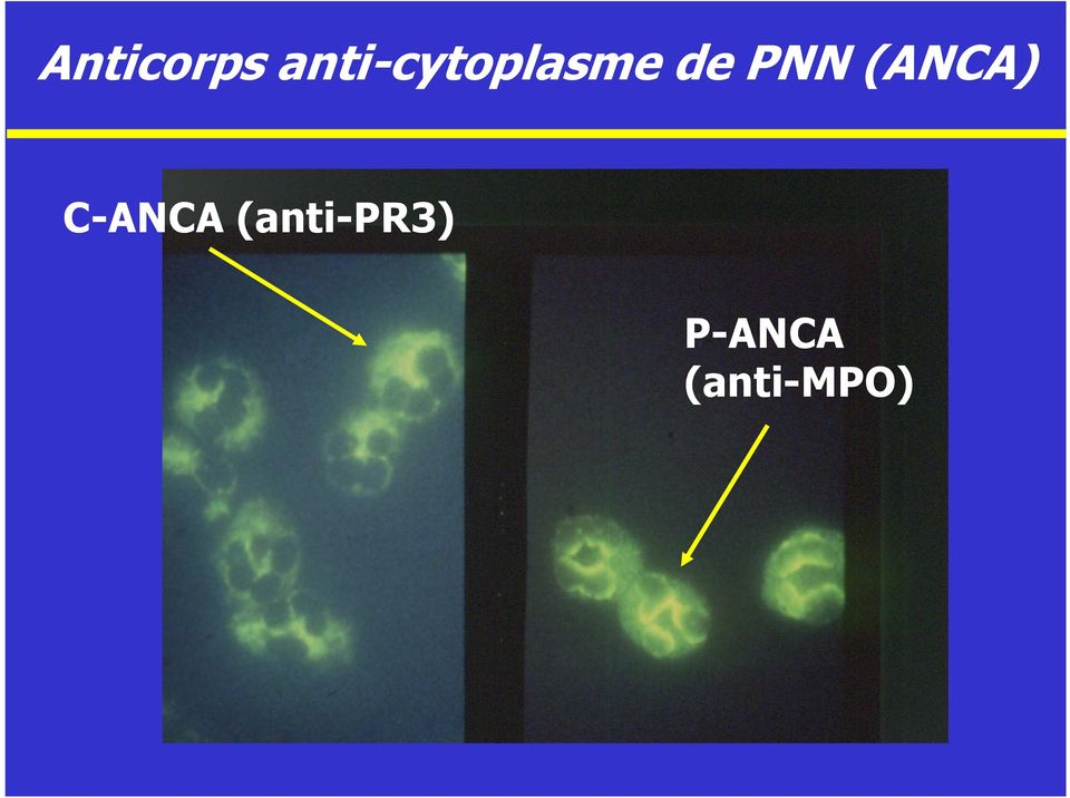 PNN (ANCA) C-ANCA