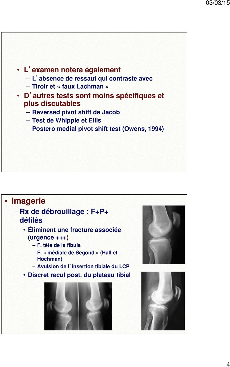 (Owens, 1994) Imagerie Rx de débrouillage : F+P+ défilés Éliminent une fracture associée (urgence +++) F.