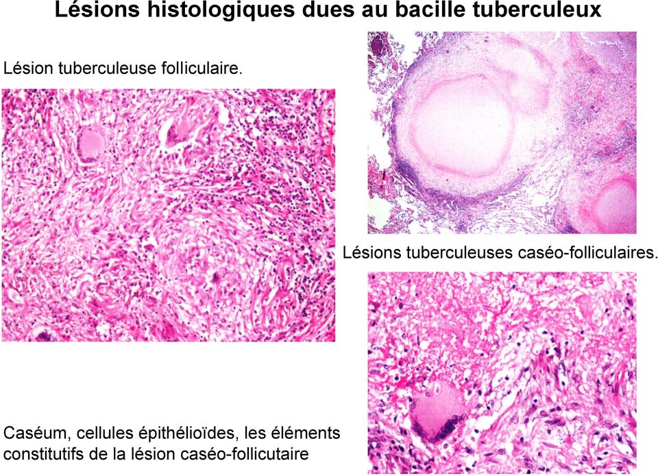 Lésions tuberculeuses caséo-folliculaires.