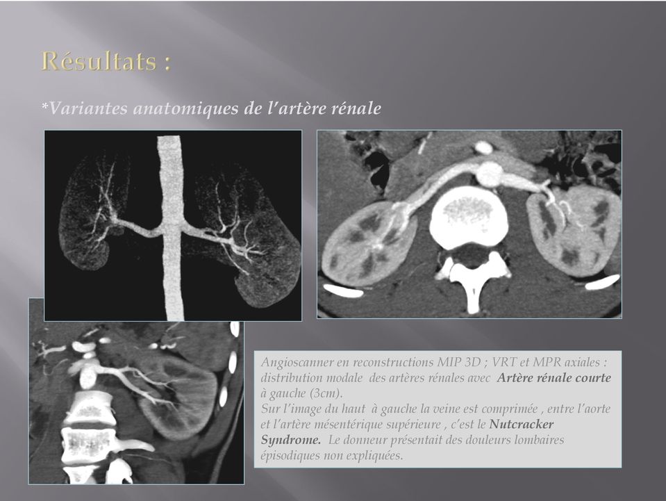 Sur l image du haut à gauche la veine est comprimée, entre l aorte et l artère mésentérique