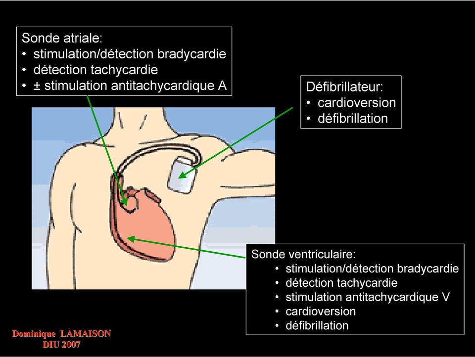 défibrillation Sonde ventriculaire: stimulation/détection bradycardie