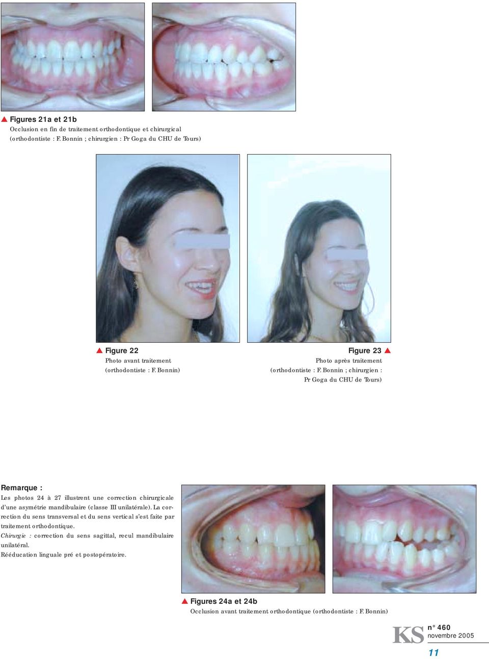 Bonnin ; chirurgien : Pr Goga du CHU de Tours) Remarque : Les photos 24 à 27 illustrent une correction chirurgicale d une asymétrie mandibulaire (classe III unilatérale).